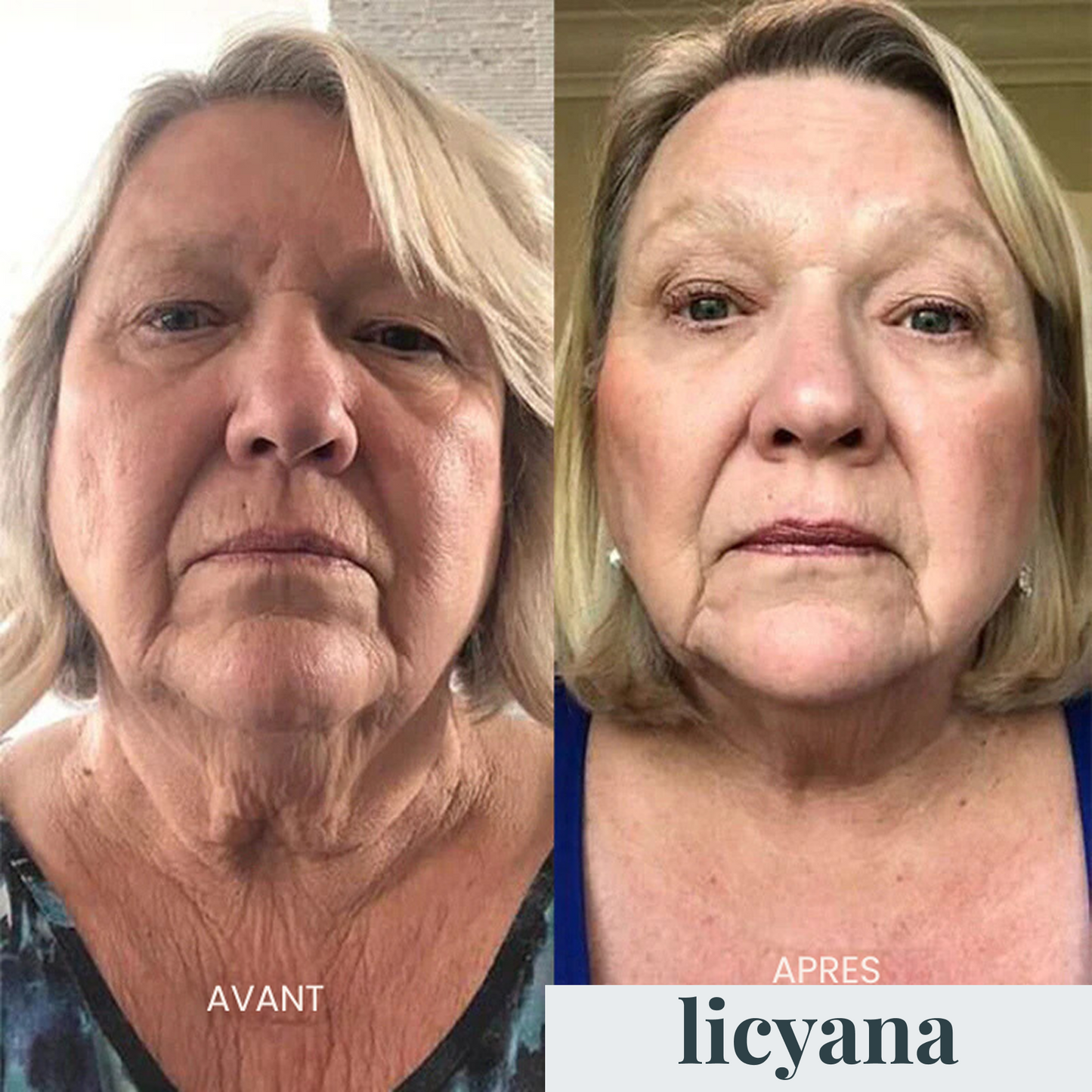 Micro Infusion Anti-âge Lift Pro™