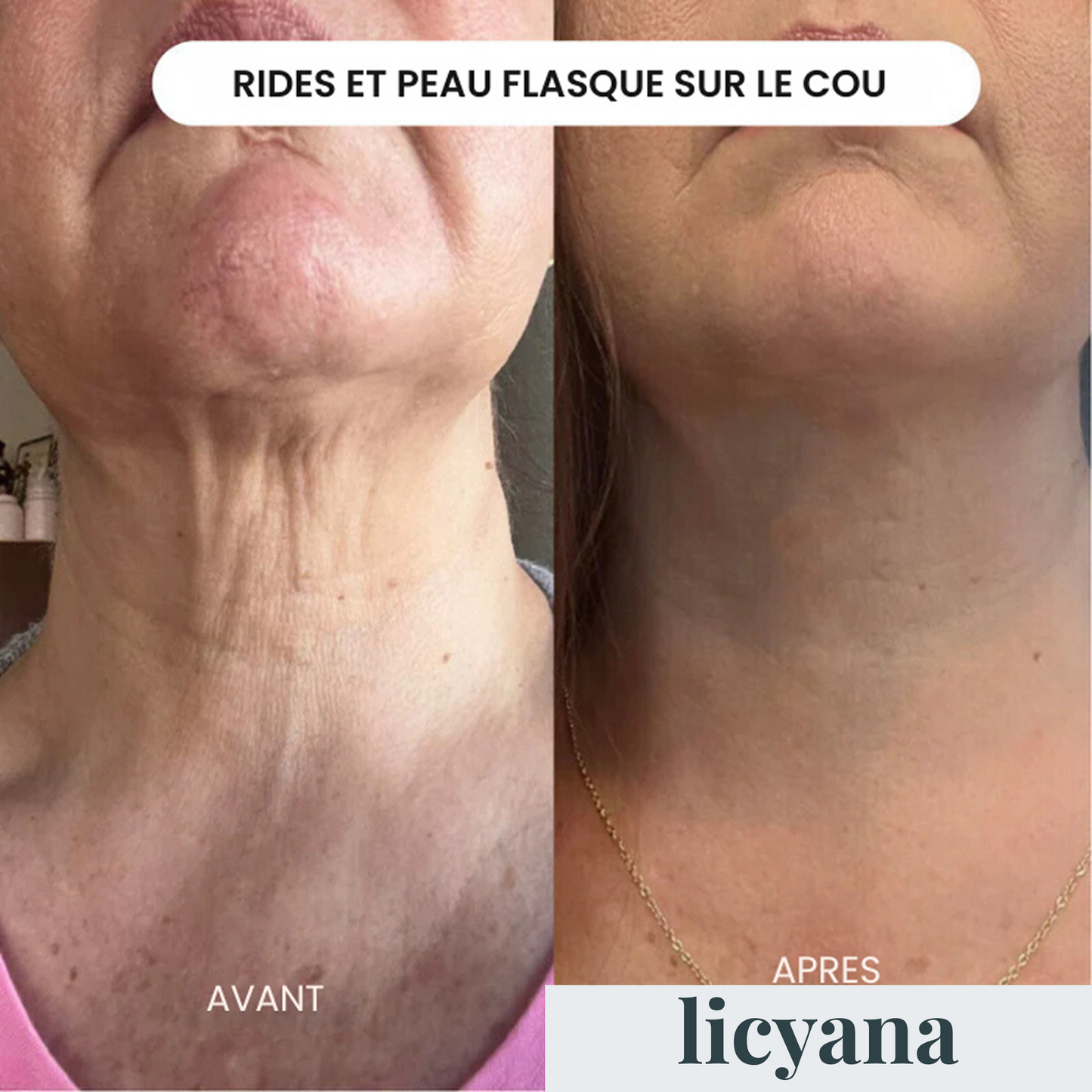 Micro Infusion Anti-âge Lift Pro™
