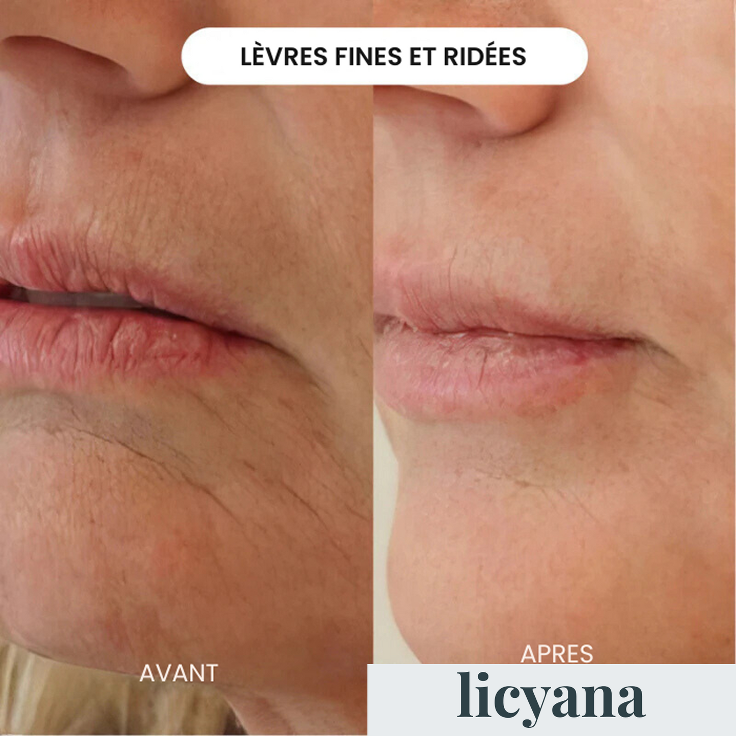 Micro Infusion Anti-âge Lift Pro™