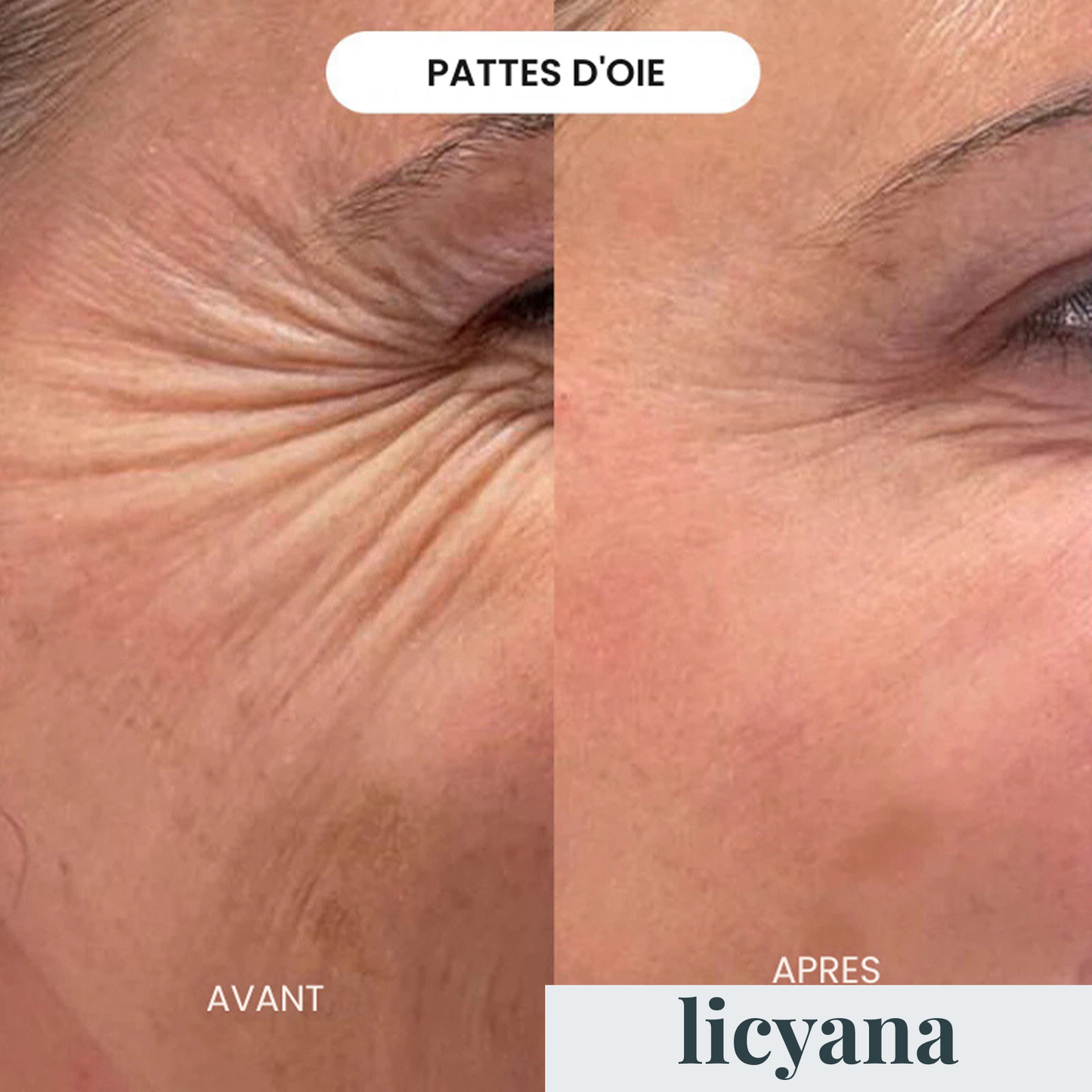 Micro Infusion Anti-âge Lift Pro™