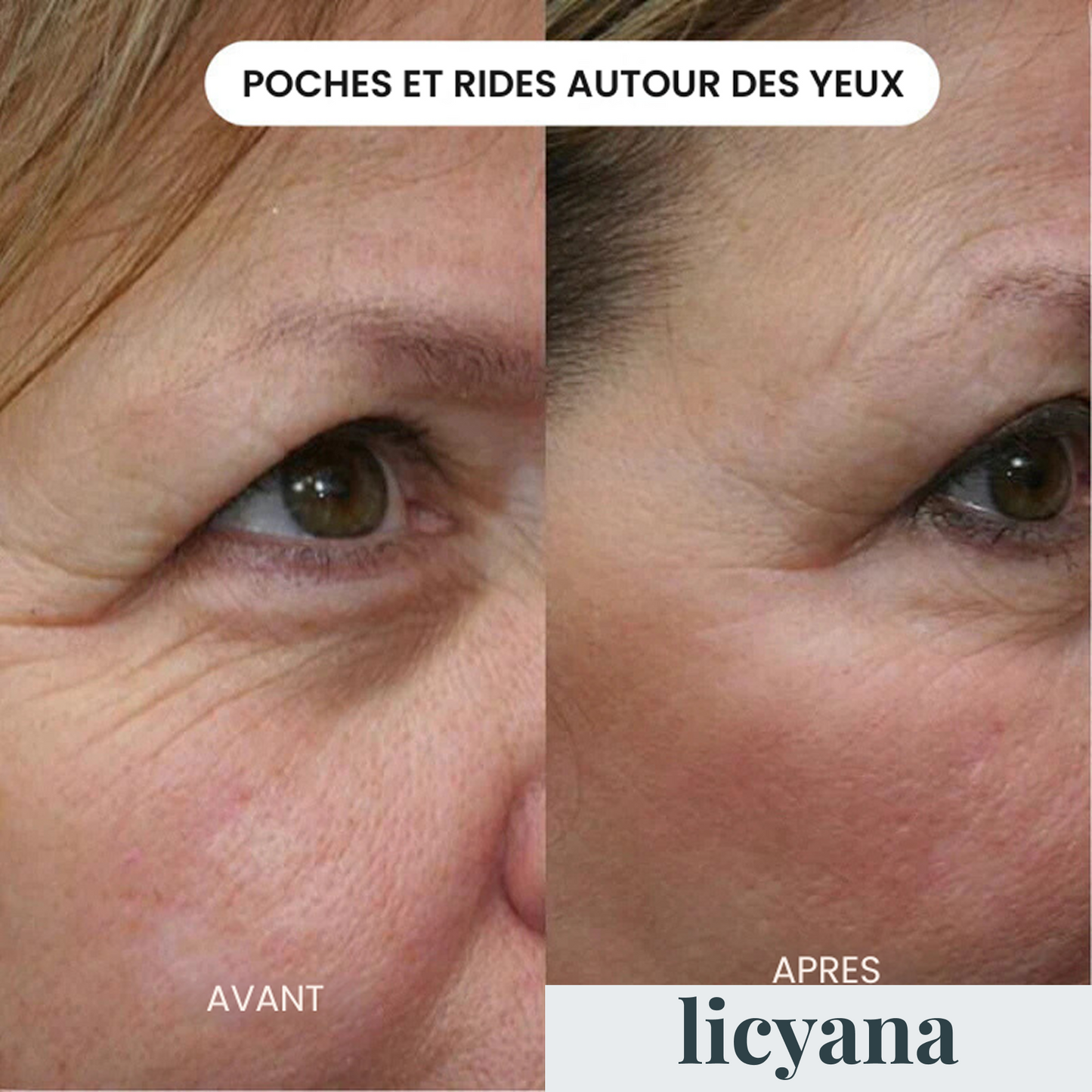 Micro Infusion Anti-âge Lift Pro™