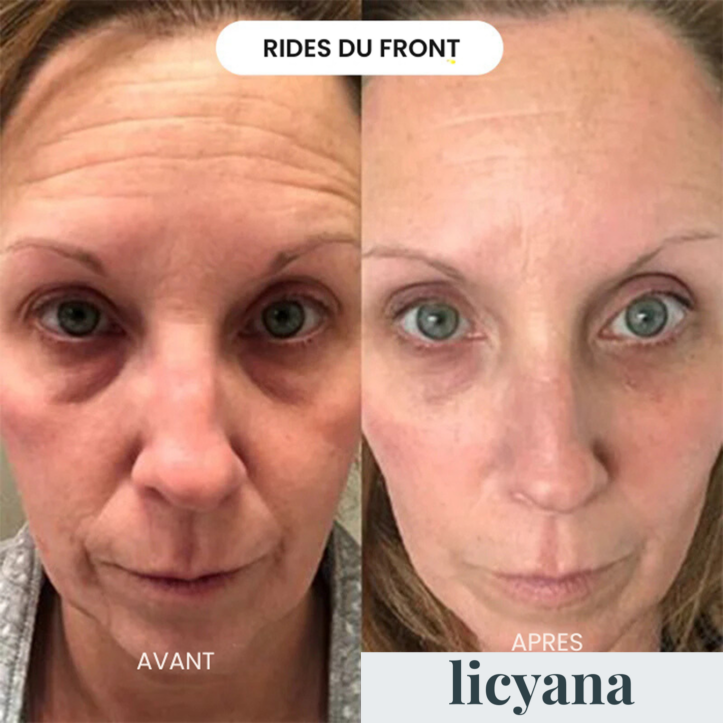 Micro Infusion Anti-âge Lift Pro™