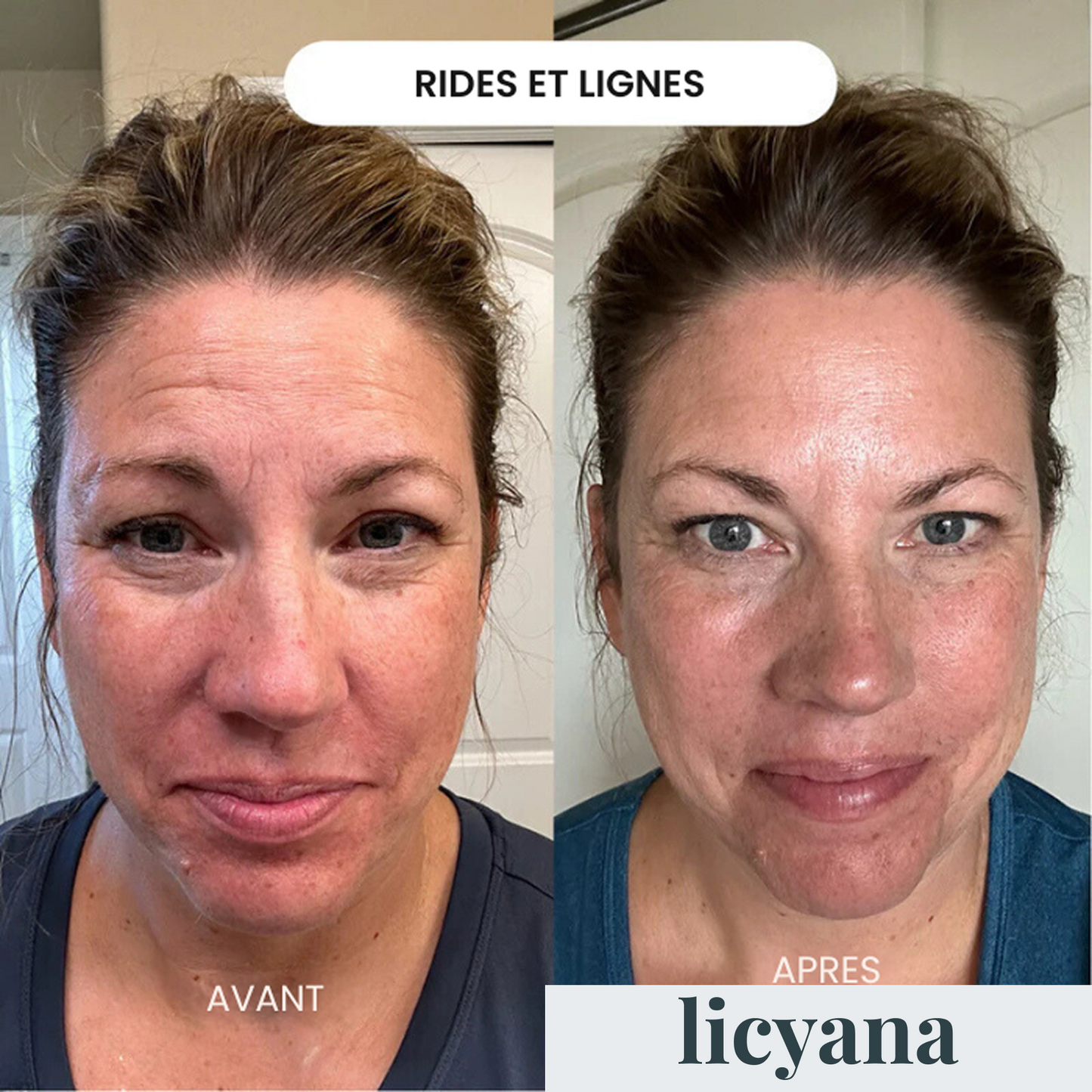 Micro Infusion Anti-âge Lift Pro™