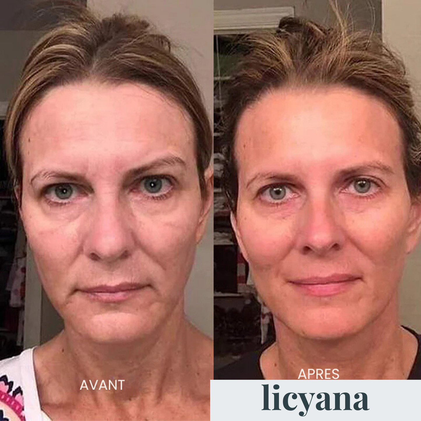 Micro Infusion Anti-âge Lift Pro™