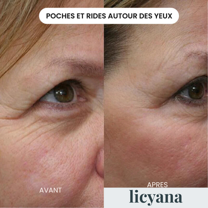 Micro Infusion Anti-âge Lift Pro™